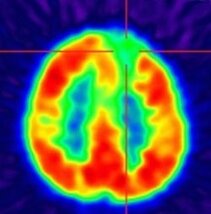 FDG-PET for hypometabolic area detection (here: focal-cortical dysplasia in the frontal part on the left side) (Department of Nuclear Medicine) FDG-PET for hypometabolic area detection (here: focal-cortical dysplasia in the frontal part on the left side) (Department of Nuclear Medicine)