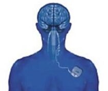 Vagus nerve stimulator Vagus nerve stimulator