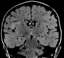 Detection of neuronal migration abnormality (cortical dysplasia) Department of Neuroradiology Detection of neuronal migration abnormality (cortical dysplasia) Department of Neuroradiology