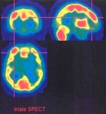 Ictal hyperperfusion in SPECT in case of cryptogenic frontal focal-cortical dysplasia (Department of Nuclear Medicine) Ictal hyperperfusion in SPECT in case of cryptogenic frontal focal-cortical dysplasia (Department of Nuclear Medicine)